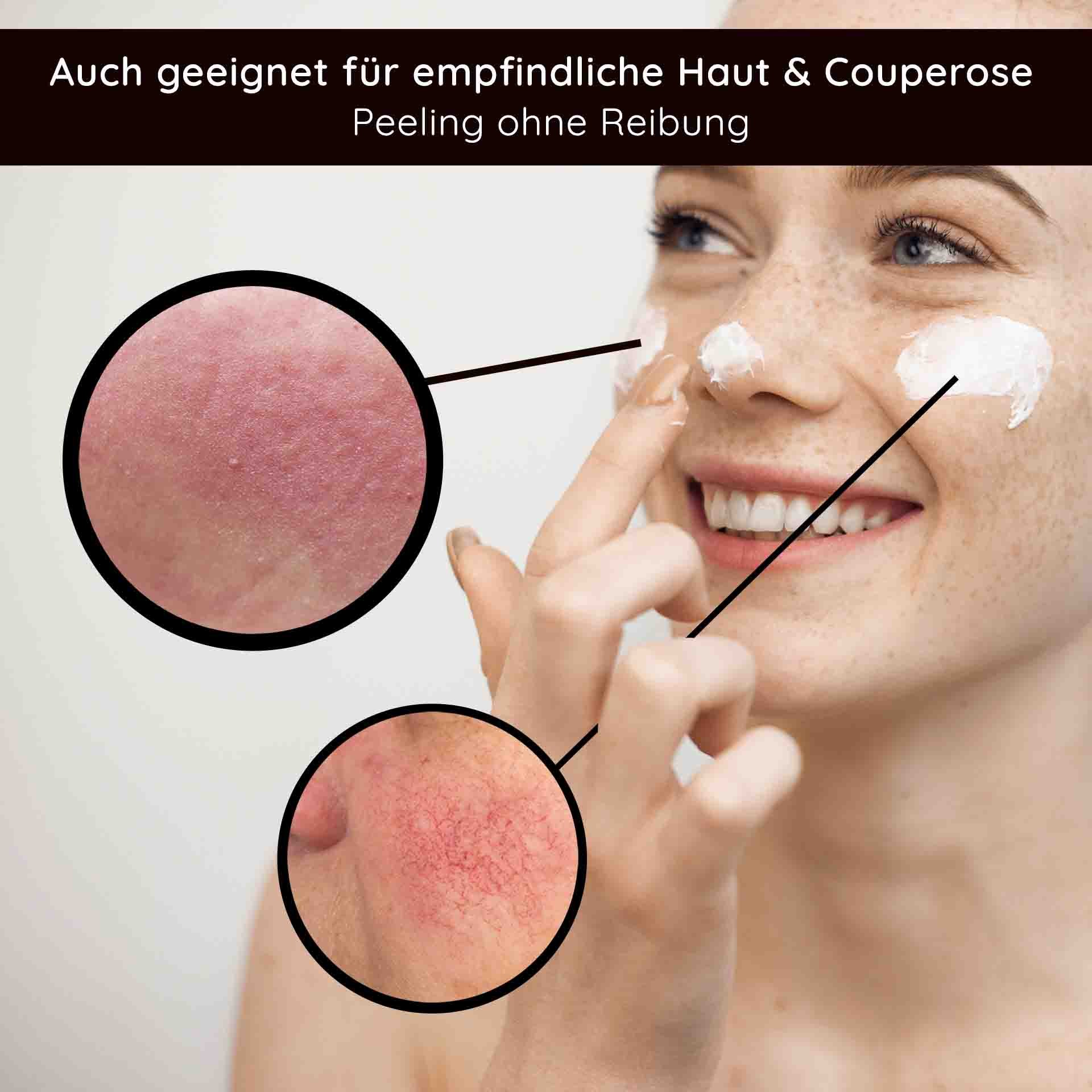 Donna con sorriso gioioso che applica un peeling ai frutti acidi sul viso, con primi piani di pelle sensibile e arrossamenti, adatto per pelle sensibile e couperose, peeling senza sfregamento.