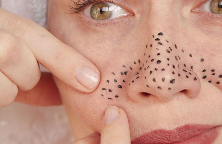 Frau mit sichtbaren Mitessern (Blackheads) auf der Nase, die sie mit den Fingern betrachtet, im Kontext der Hautpflege und Aufklärung über Hautunreinheiten.
