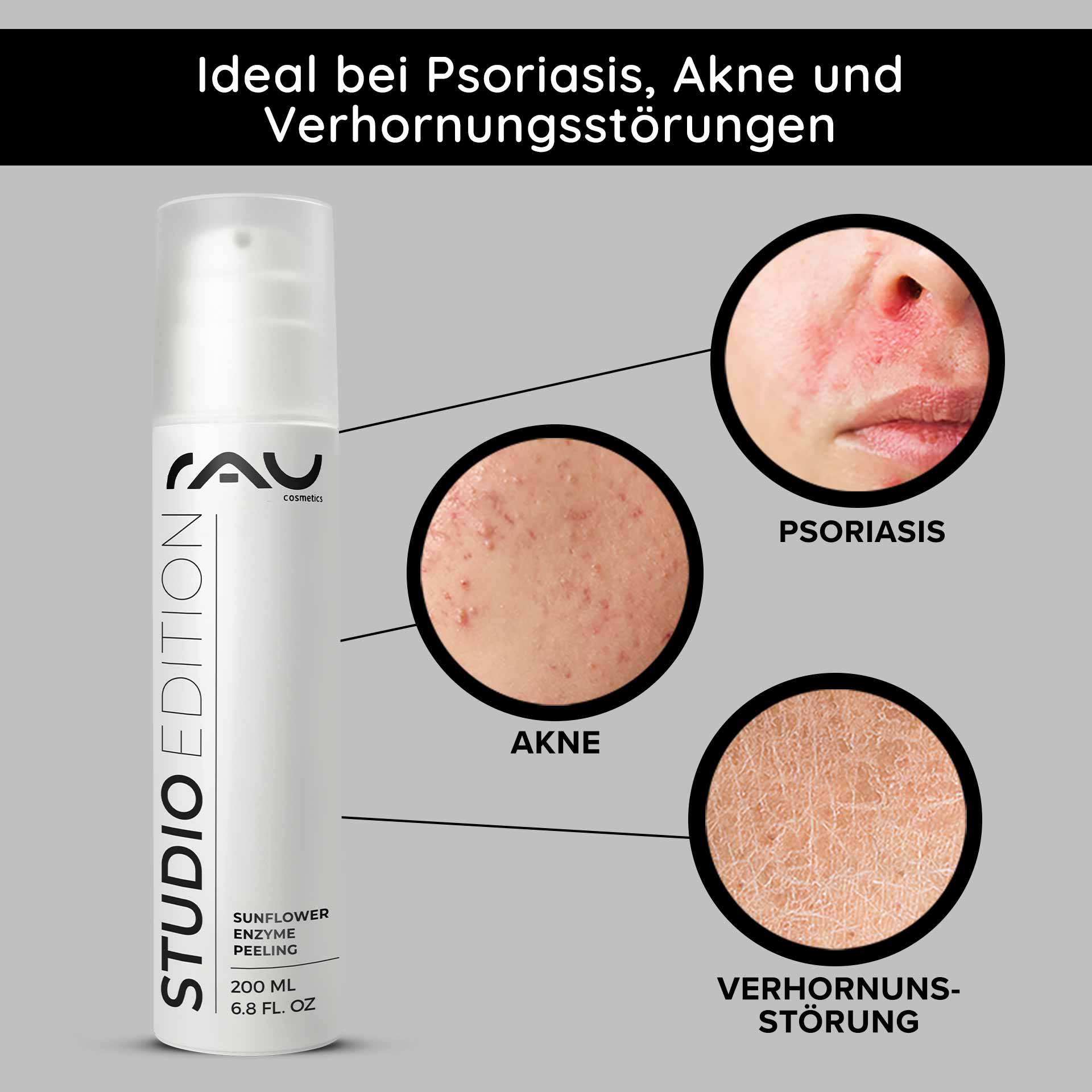 Peeling enzimatico al girasole 200 ml Peeling enzimatico chimico Verpackung des RAU Sunflower Enzyme Peeling mit hervorgehobenen Vorteilen bei Schuppenflechte, Akne und Keratose; Nahaufnahmen von Hautzuständen veranschaulichen die Wirksamkeit.