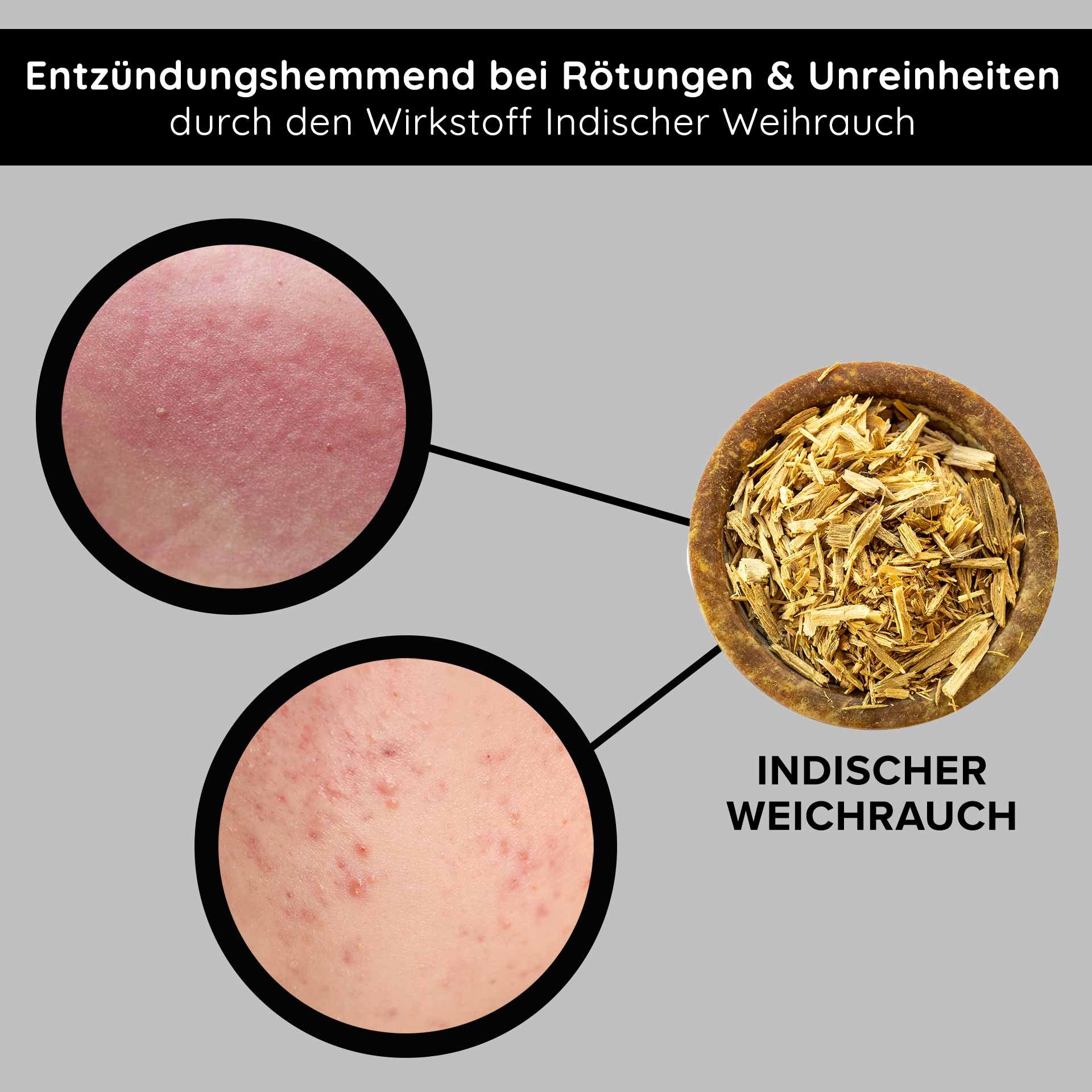 Entzündungshemmendes Indischer Weihrauch zur Reduzierung von Rötungen e Unreinheiten, con Nahaufnahmen von betroffener pelle.