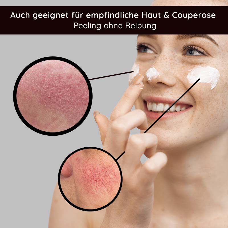 Peeling agli acidi della frutta 100 ml Peeling agli acidi della frutta con BHA Frau mit fröhlichem Gesicht, die Fruchtsäurepeeling auf die Haut aufträgt, um empfindliche Haut und Couperose zu behandeln, mit Nahaufnahmen von geröteter Haut und Peelingeffekten.