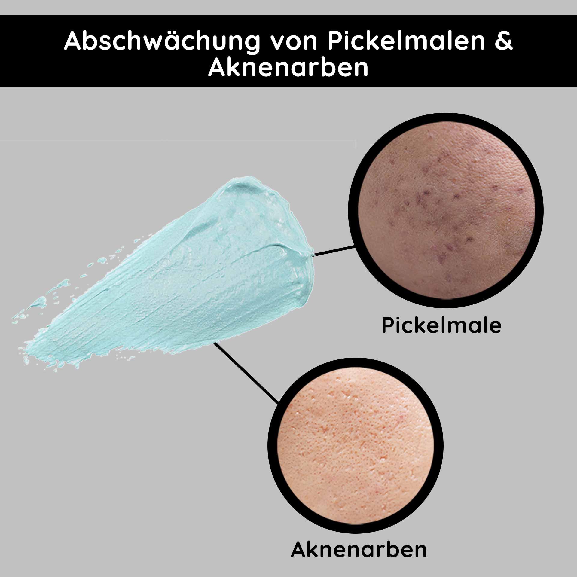 Attenuazione dei segni dei brufoli e delle cicatrici da acne con crema blu, confronto delle texture cutanee per prodotti di cura della pelle.