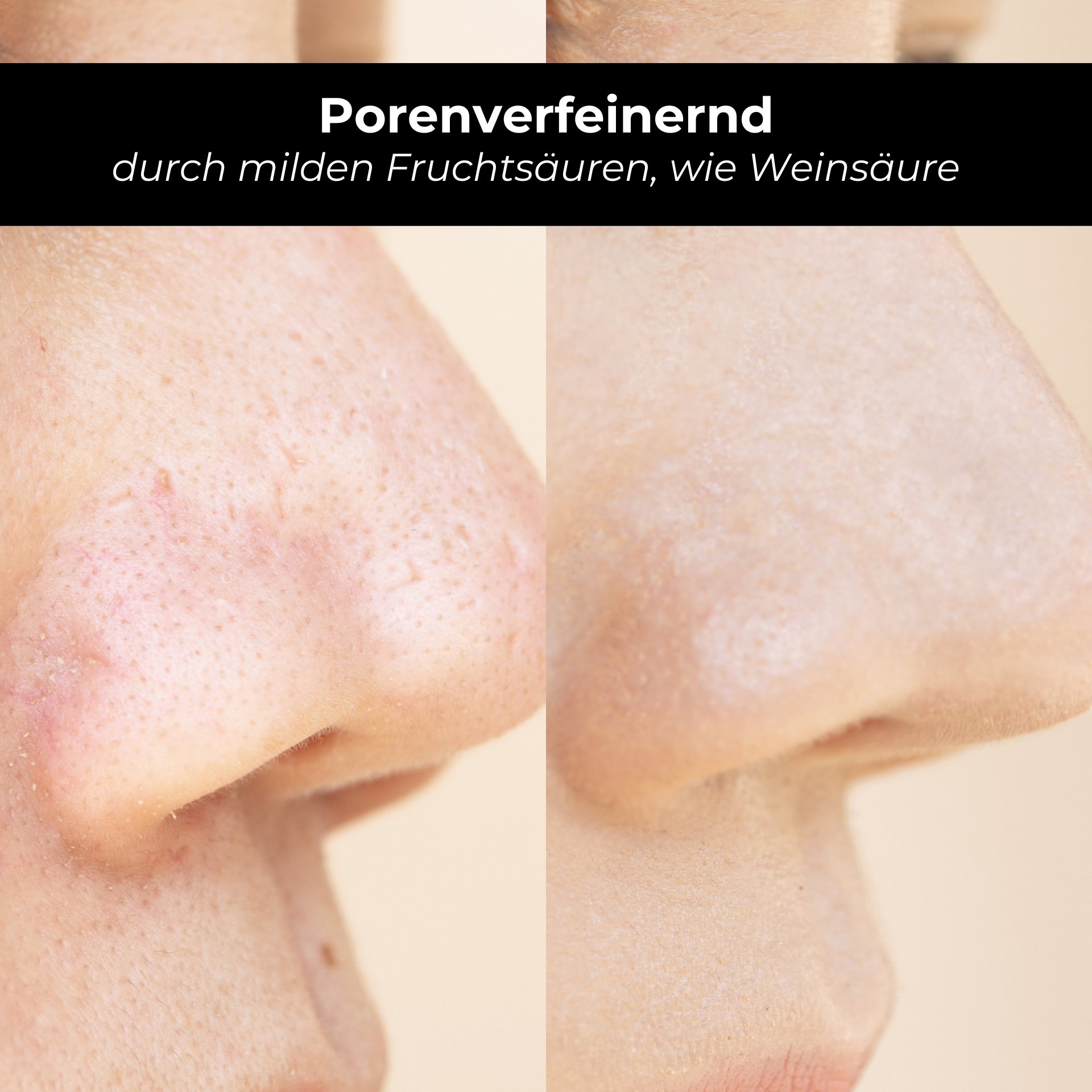 Verfeinerte pori: Vorher-Nachher Vergleich des Hautbildes nach del Applicazione von Weinsäure e Fruchtsäuren.