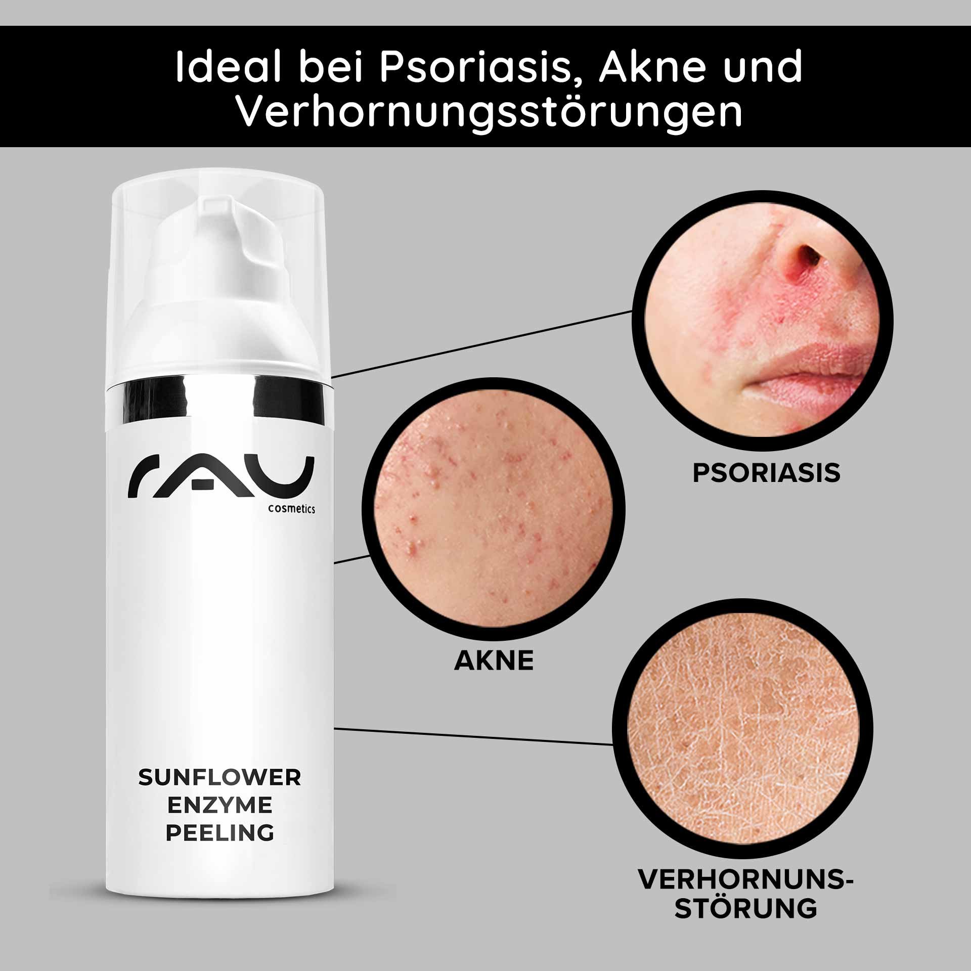 Confezione del Sunflower Enzyme Peeling di RAU Cosmetics con evidenziati i problemi della pelle: psoriasi, acne e ipercheratosi.