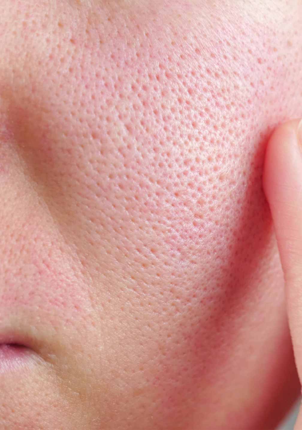 Nahaufnahme der Hauttextur mit deutlichen Poren, Finger berührt die Haut; RAU Cosmetics Caviar Pore Minimizer.